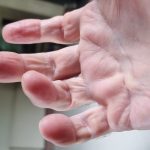 Second surgery outcomes