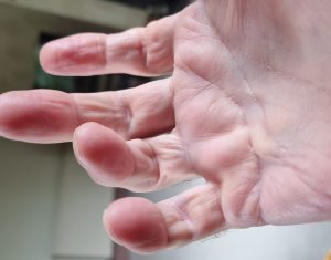 Second surgery outcomes