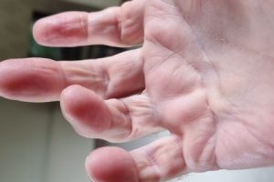 Second surgery outcomes